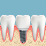 Dental Implants at Leinassar Dental Excellence, Astoria Oregon