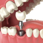 Dental implants, Leinassar Dental Excellence, Astoria, Oregon